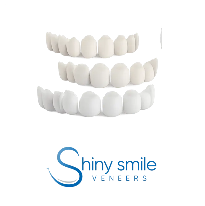 Shiny Smile snap-on veneers for a natural-looking whiter smile
